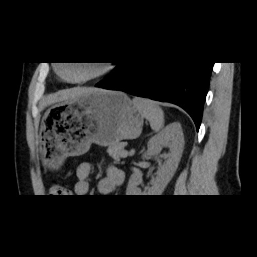 File:Adrenal gland trauma (Radiopaedia 81351-95079 Sagittal non-contrast 71).jpg