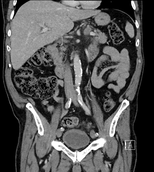 Adrenal lymphoma (Radiopaedia 73730-84529 Coronal C+ portal venous phase 37).jpg