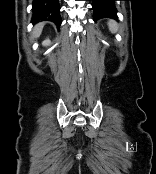 Adrenal lymphoma (Radiopaedia 73730-84529 Coronal C+ portal venous phase 71).jpg