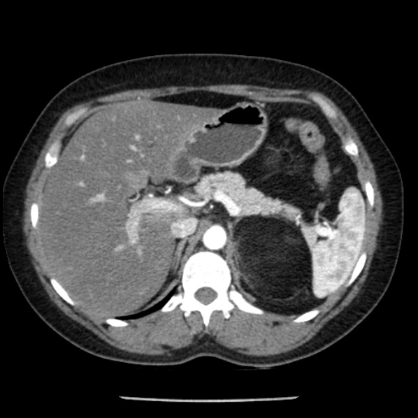 Adrenal myelolipoma (Radiopaedia 43401-46759 Axial C+ arterial phase 27).jpg