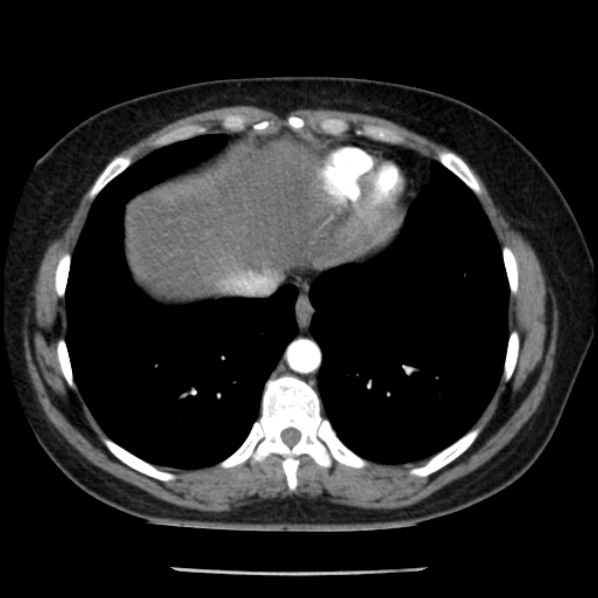 Adrenal myelolipoma (Radiopaedia 43401-46759 Axial C+ arterial phase 7).jpg
