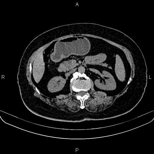 Adrenal myelolipoma (Radiopaedia 82742-96986 Axial non-contrast 64).jpg