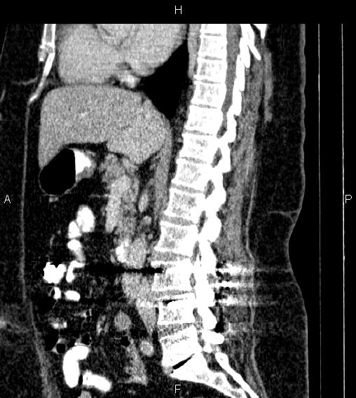 Adrenal myelolipoma (Radiopaedia 84319-99617 Sagittal renal cortical phase 46).jpg