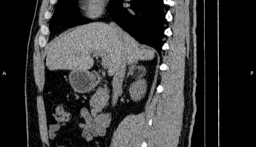 Adrenal myelolipoma (Radiopaedia 84321-99619 Sagittal non-contrast 43).jpg