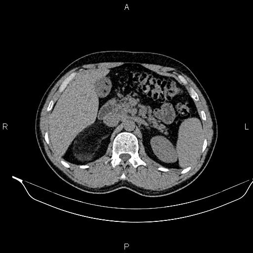 Adrenal myelolipoma (Radiopaedia 87794-104246 Axial non-contrast 37).jpg