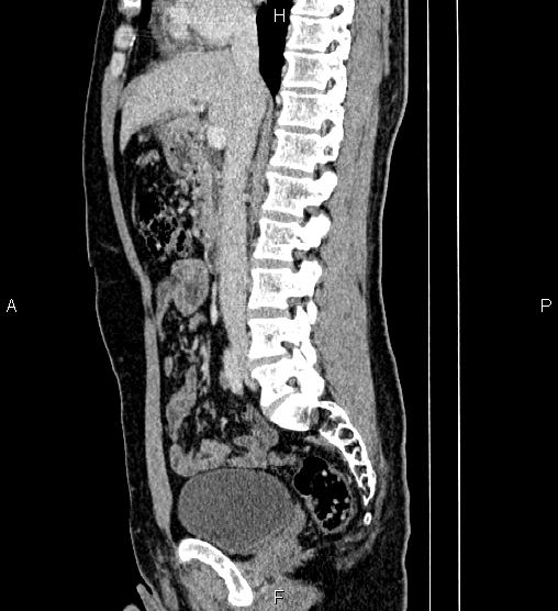 Adrenal myelolipoma (Radiopaedia 87794-104246 Sagittal renal cortical phase 42).jpg