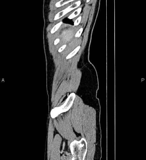 Adrenal myelolipoma (Radiopaedia 87794-104246 Sagittal renal cortical phase 91).jpg