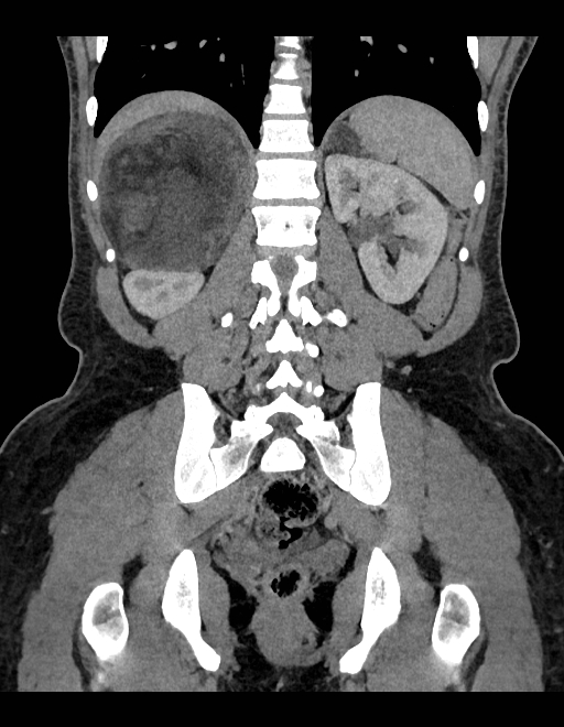 Adrenal myelolipoma - bilateral (Radiopaedia 74805-85810 Coronal C+ portal venous phase 107).jpg