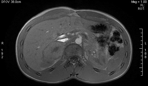 File:Adrenal pheochromocytoma (Radiopaedia 35133-36730 Axial T1 out-of-phase 6).jpg