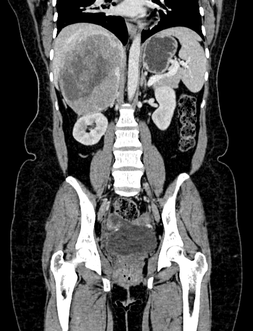 Adrenocortical carcinoma (Radiopaedia 87281-103569 Coronal C+ portal venous phase 68).jpg