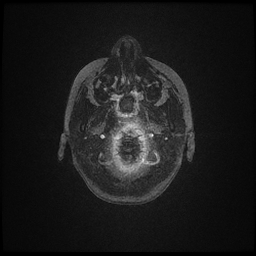 Adrenoleukodystrophy (Radiopaedia 60905-68711 Axial T1 1).jpg
