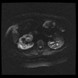 Adult polycystic kidney disease (Radiopaedia 59075-66365 Axial DWI 48).jpg