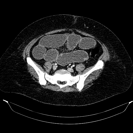 File:Afferent loop syndrome - secondary to incarcerated trocar site hernia (Radiopaedia 82959-97305 Axial C+ portal venous phase 171).jpg