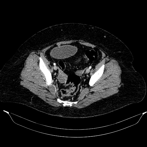 Afferent loop syndrome - secondary to incarcerated trocar site hernia (Radiopaedia 82959-97305 Axial C+ portal venous phase 200).jpg