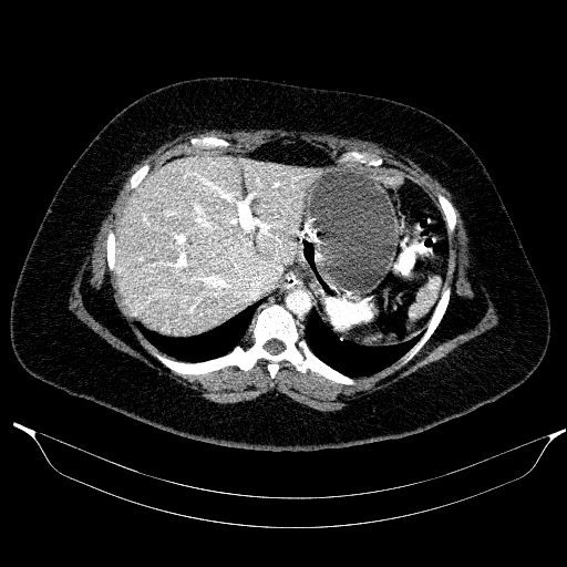 File:Afferent loop syndrome - secondary to incarcerated trocar site hernia (Radiopaedia 82959-97305 Axial C+ portal venous phase 45).jpg