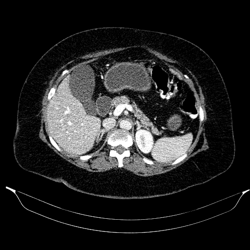 File:Afferent loop syndrome - secondary to incarcerated trocar site hernia (Radiopaedia 82959-97305 Axial C+ portal venous phase 75).jpg
