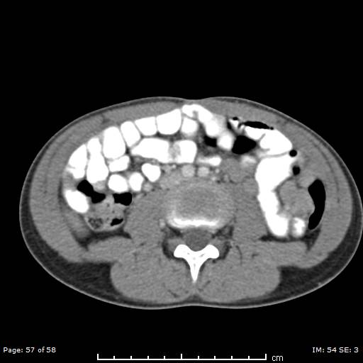 Agenesis of the gallbladder (Radiopaedia 55454-61905 B 57).jpg
