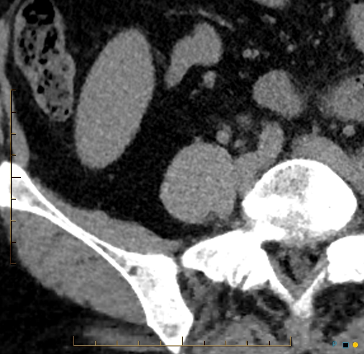 Aggressive angiomyolipoma (Radiopaedia 55765-62328 Axial non-contrast 56).jpg