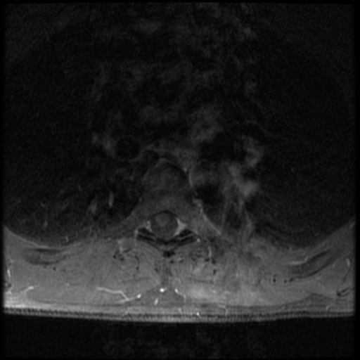 File:Aggressive vertebral hemangioma (Radiopaedia 39937-42404 Axial T1 C+ fat sat 25).png