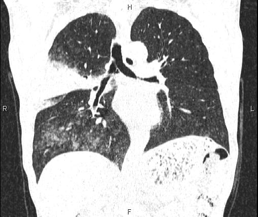 Air bronchogram in pneumonia (Radiopaedia 85719-101512 Coronal lung window 33).jpg