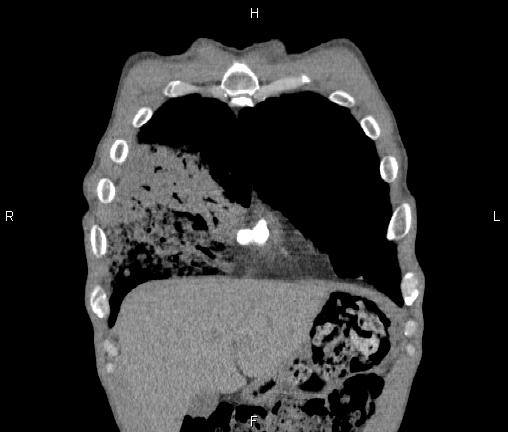 Air bronchogram in pneumonia (Radiopaedia 85719-101512 Coronal non-contrast 8).jpg