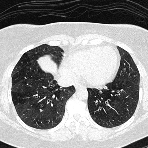 File:Air trapping in small airway disease (Radiopaedia 61685-69694 Axial lung window 128).jpg