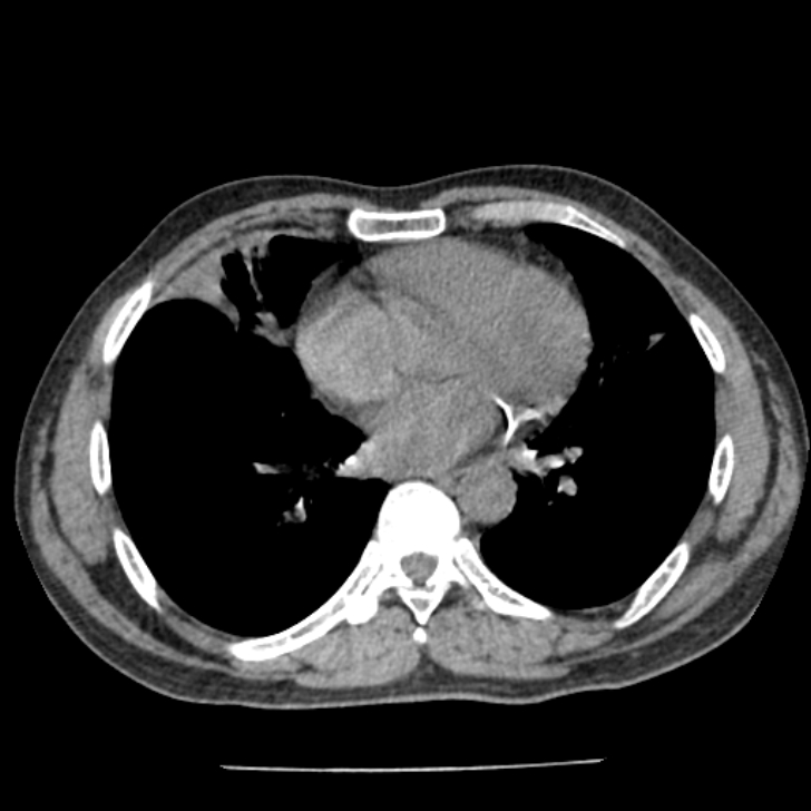 Airway foreign body in adult (Radiopaedia 85907-101779 Axial liver window 117).jpg