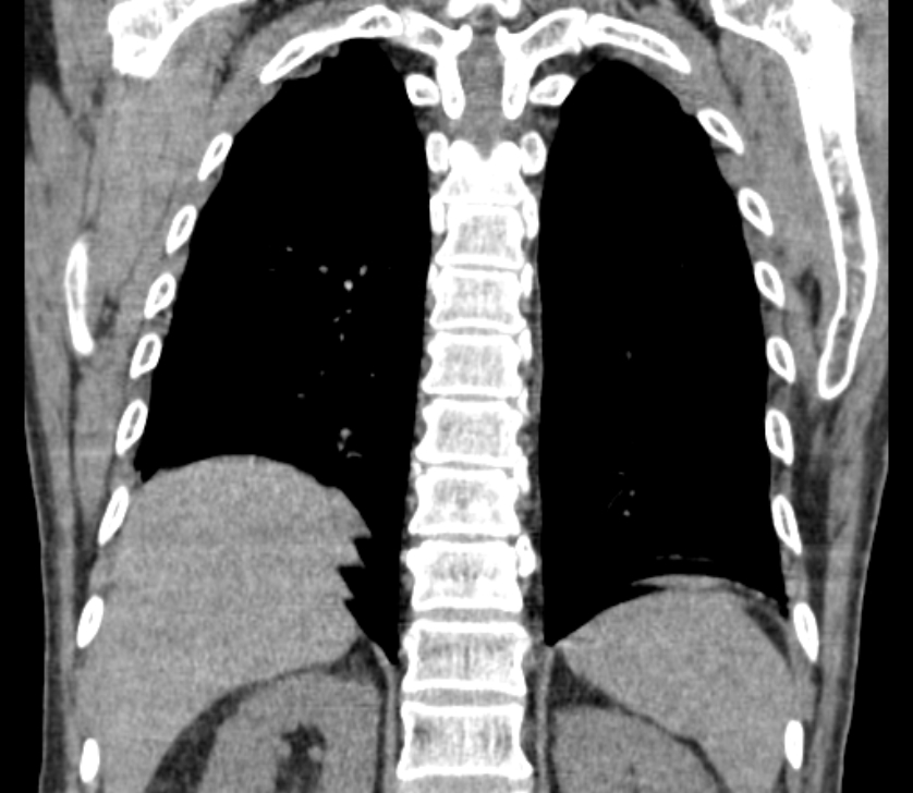 Airway foreign body in adult (Radiopaedia 85907-101779 Coronal liver window 209).jpg