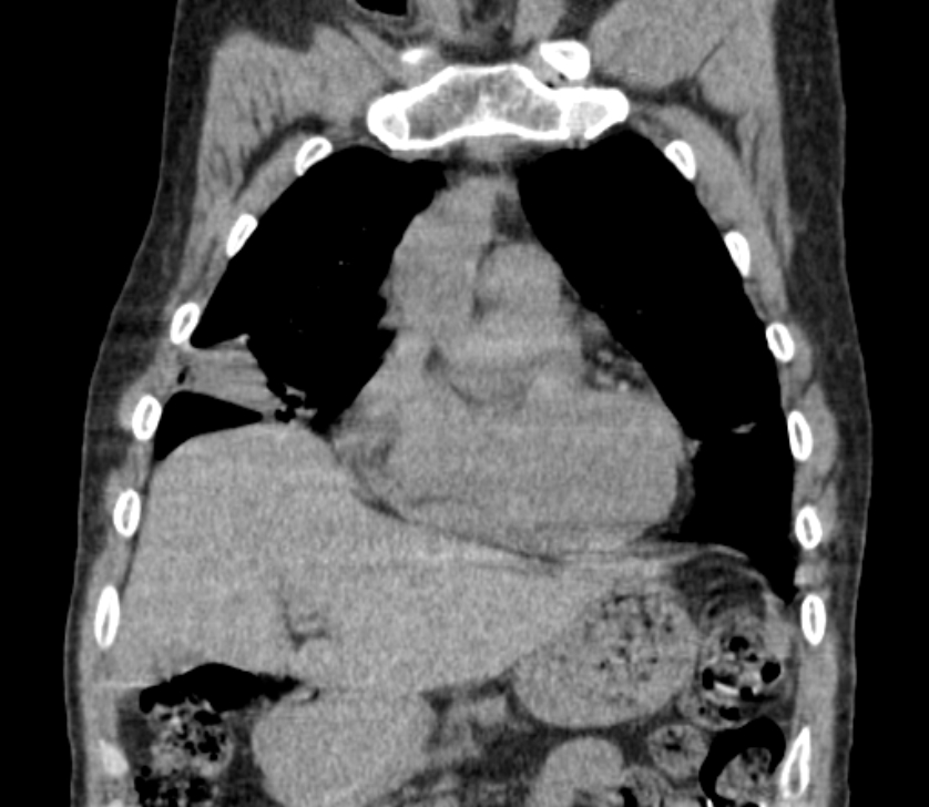 Airway foreign body in adult (Radiopaedia 85907-101779 Coronal liver window 69).jpg