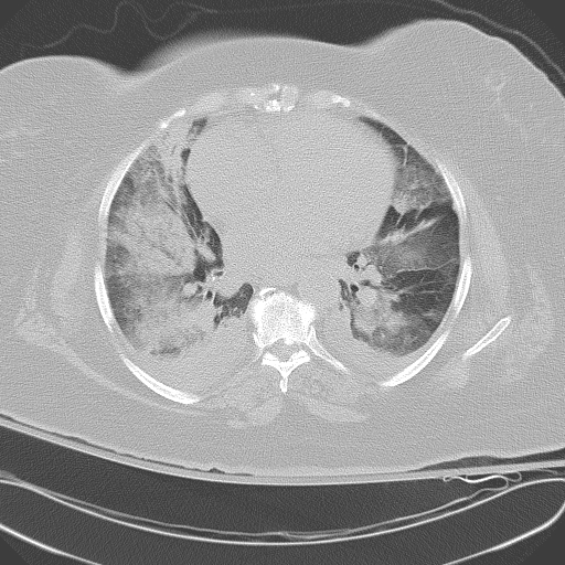 All trans retinoic acid (ATRA) syndrome (Radiopaedia 38212-40229 Axial lung window 32).jpg