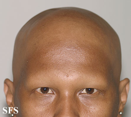 Alopecia Areata (Dermatology Atlas 35).jpg