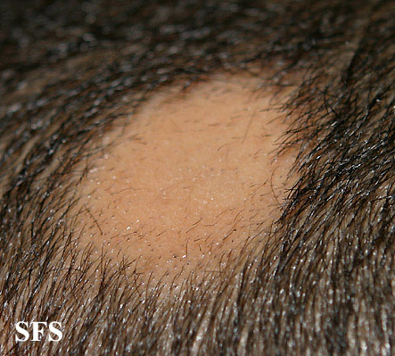 Alopecia Areata (Dermatology Atlas 49).jpg