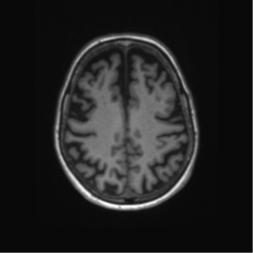 File:Alzheimer's disease (Radiopaedia 42658-45802 Axial T1 48).png