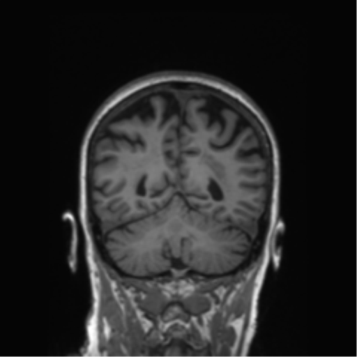 Alzheimer's disease (Radiopaedia 42658-45802 Coronal T1 61).png