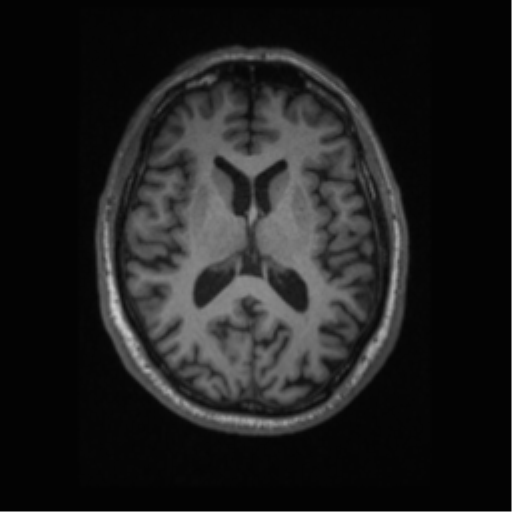 File:Alzheimer disease - probable (Radiopaedia 35334-36837 Axial T1 43).png