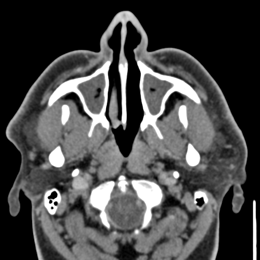 File:Ameloblastoma (Radiopaedia 33677-34806 Axial non-contrast 9).png