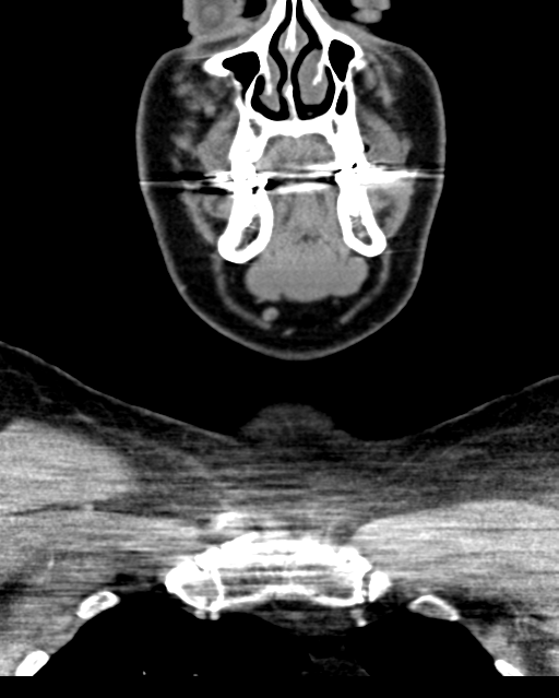 Ameloblastoma (Radiopaedia 38520-40623 Coronal non-contrast 20).png