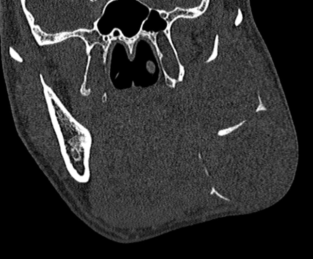 Ameloblastoma (Radiopaedia 51921-57766 Coronal bone window 128).jpg