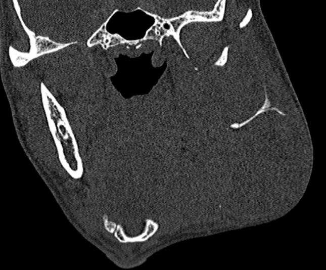 Ameloblastoma (Radiopaedia 51921-57766 Coronal bone window 145).jpg