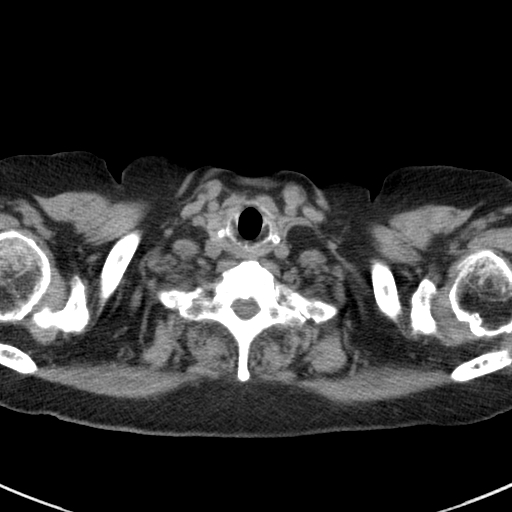 File:Amiodarone-induced pulmonary fibrosis (Radiopaedia 82355-96460 Axial non-contrast 5).jpg