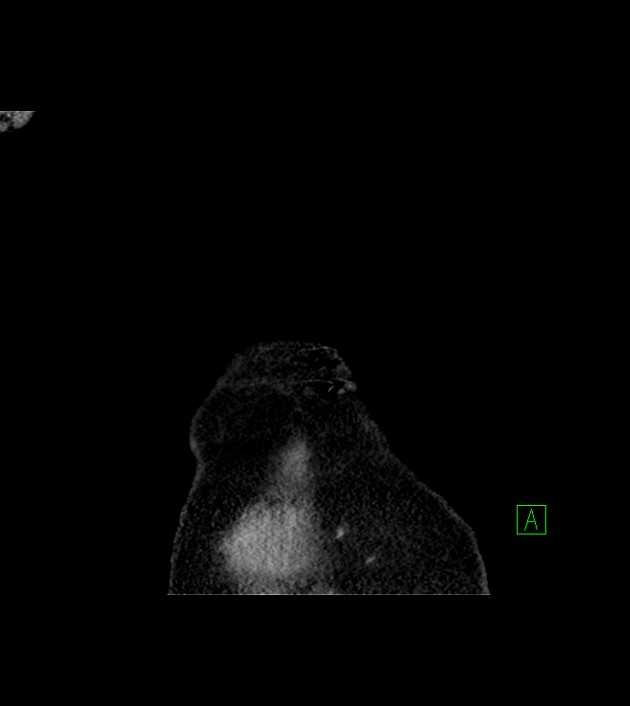 Amiodarone deposition in the liver (Radiopaedia 77587-89780 Coronal non-contrast 7).jpg