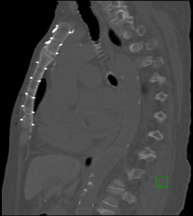 Amiodarone deposition in the liver (Radiopaedia 77587-89780 Sagittal bone window 47).jpg