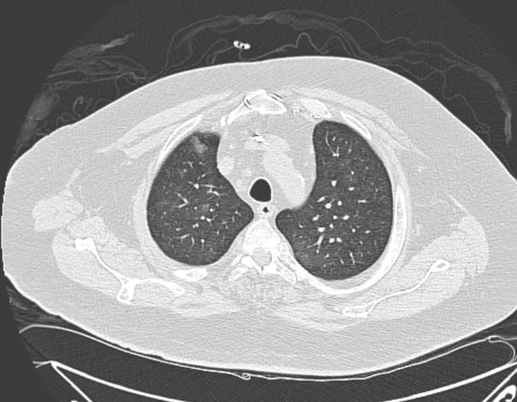 File:Amiodarone lung (Radiopaedia 62514-70769 Axial lung window 20).jpg