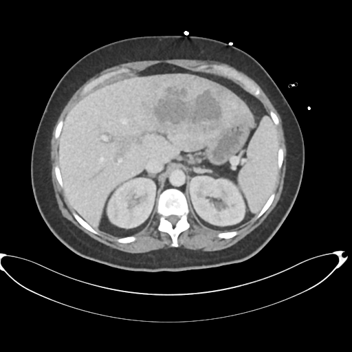 File:Amoebic liver abscess (Radiopaedia 52611-58530 A 27).png