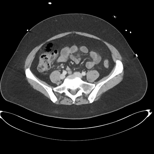 File:Amoebic liver abscess (Radiopaedia 52611-58530 A 69).png