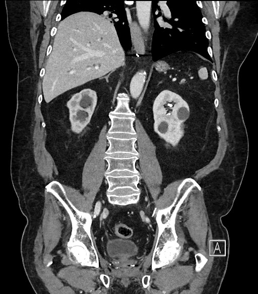 Ampullary adenocarcinoma (Radiopaedia 59373-66734 D 71).jpg