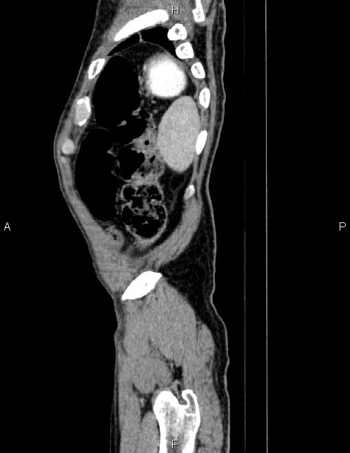 Ampullary adenocarcinoma (Radiopaedia 86093-102032 D 91).jpg