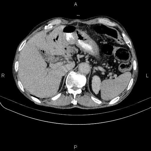 Ampullary adenocarcinoma (Radiopaedia 86093-102033 Axial C+ delayed 28).jpg