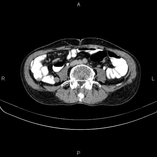 Ampullary adenocarcinoma (Radiopaedia 86093-102033 Axial C+ delayed 81).jpg