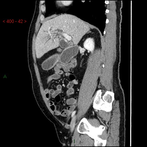 Ampullary carcinoma (Radiopaedia 56396-63056 D 41).jpg